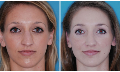 Rhinoplasty NYC