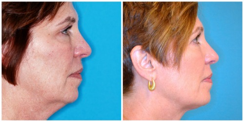 neck liposuction