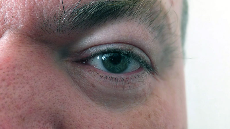 Good Candidate for Blepharoplasty